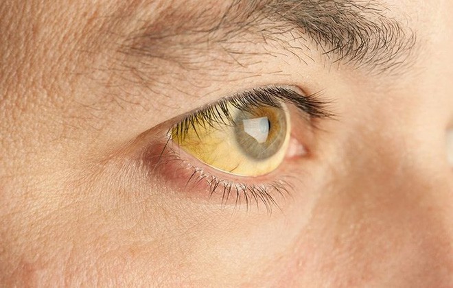 jaundice pancreatic cancer — yellow discoloration of skin and sclera from biliary obstruction by head-of-pancreas tumor