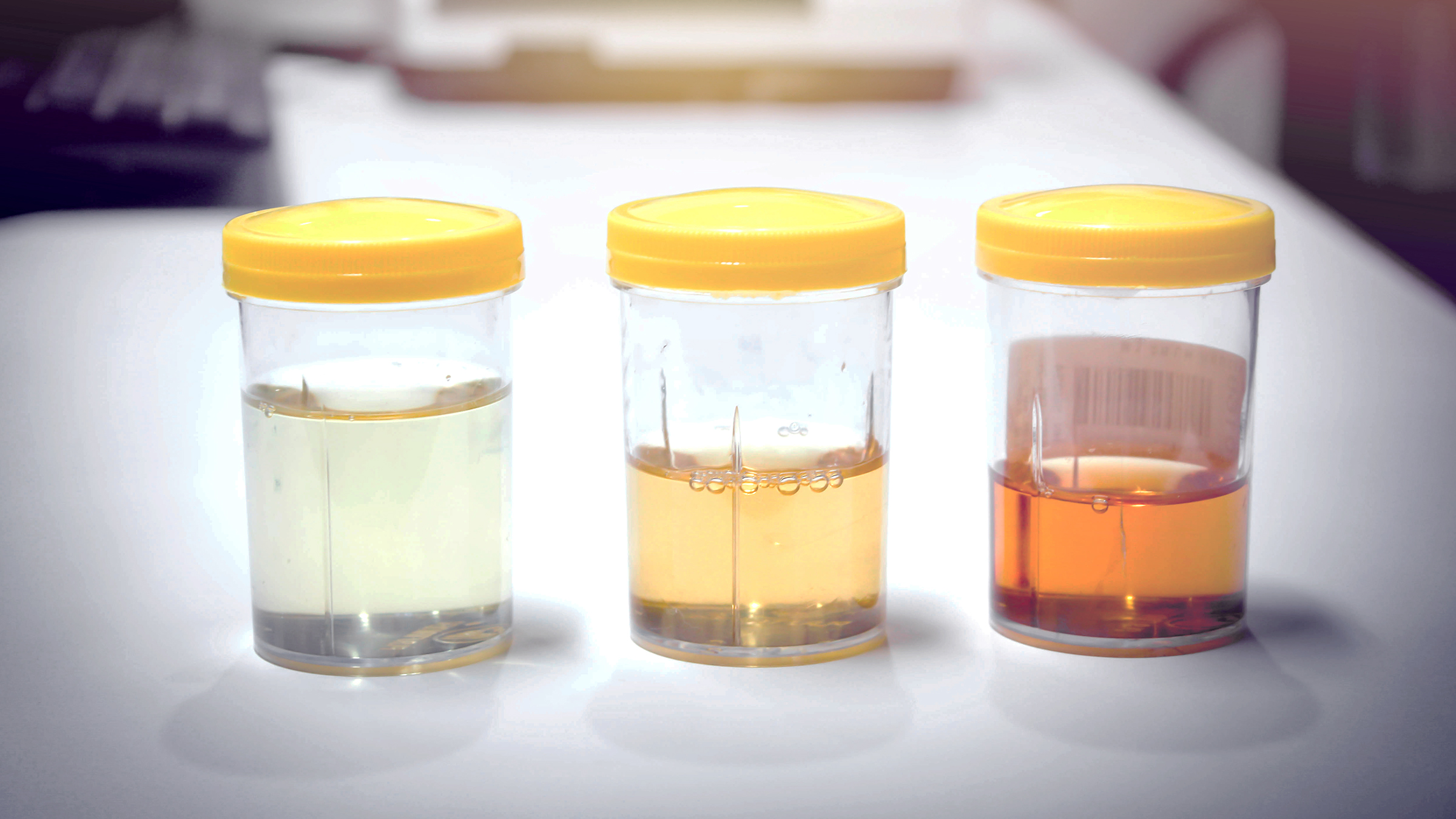 blood in urine (hematuria) — a key kidney cancer symptom that requires urgent medical evaluation even when painless