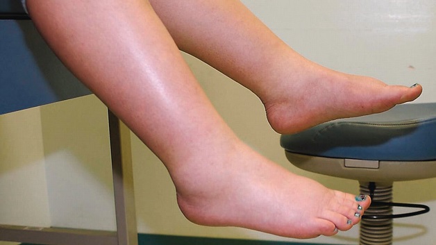 heart failure edema swollen ankles pitting edema assessment