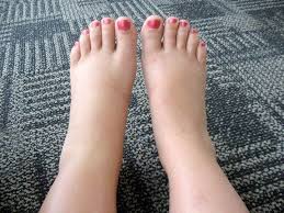 leg swelling edema caused by heart failure and venous congestion
