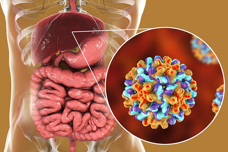 liver cancer and hepatitis — chronic HBV and HCV infection leading to hepatocellular carcinoma in cirrhotic liver
