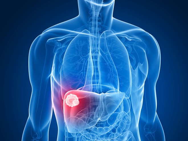 TACE treatment for liver cancer — transarterial chemoembolization delivering chemotherapy through hepatic artery to liver tumor