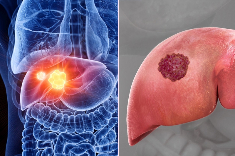 liver cancer — hepatocellular carcinoma in cirrhotic liver showing risk factors, staging, and treatment options