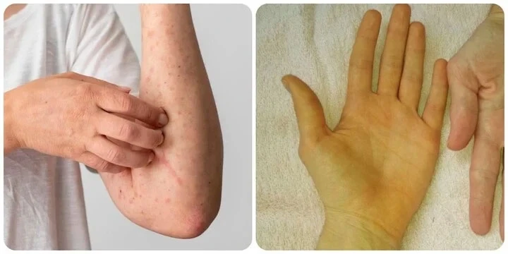 liver cancer abdominal swelling and ascites — fluid accumulation from hepatocellular carcinoma causing worsening portal hypertension