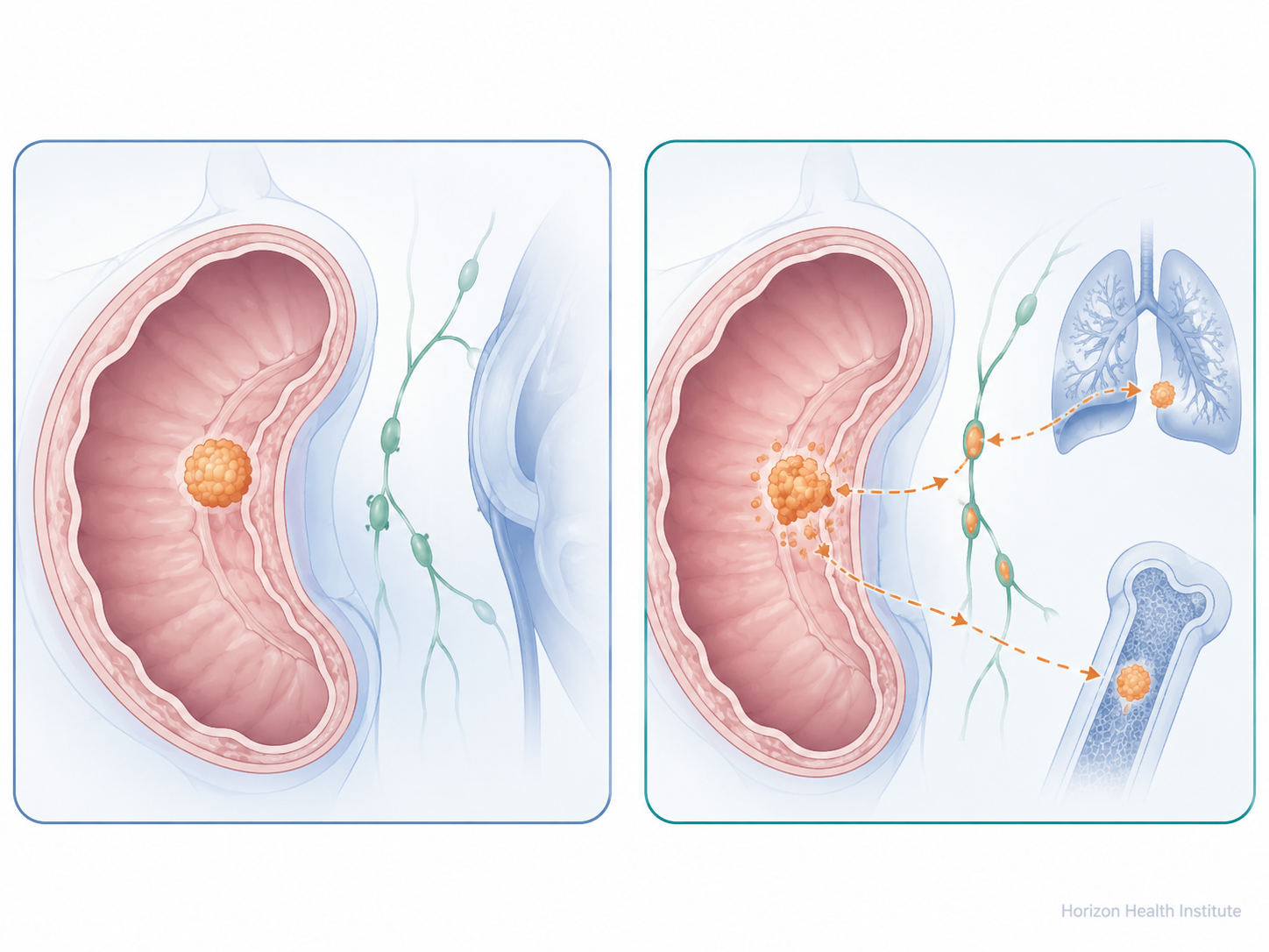 How doctors determine if cancer is localized — staging process diagram
