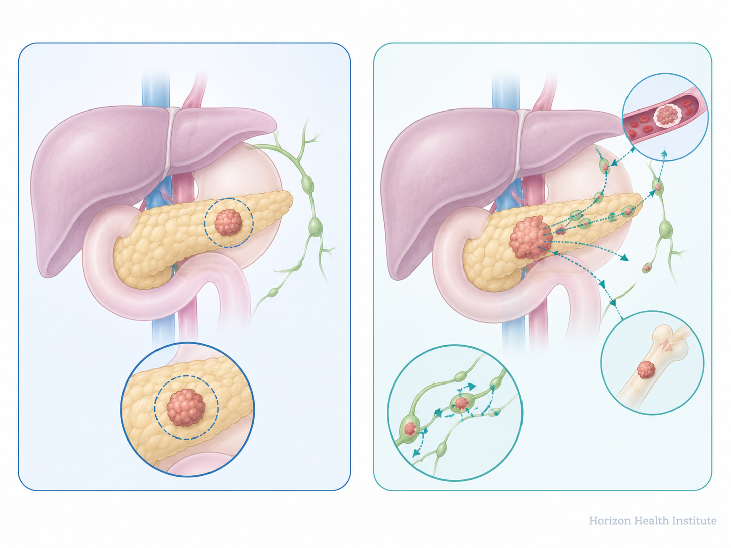 Localized cancer survival rates by cancer type — 5-year survival statistics