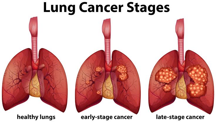 low dose CT lung cancer screening scan result chest