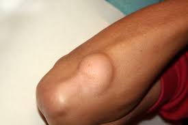 lump under skin cancer featured