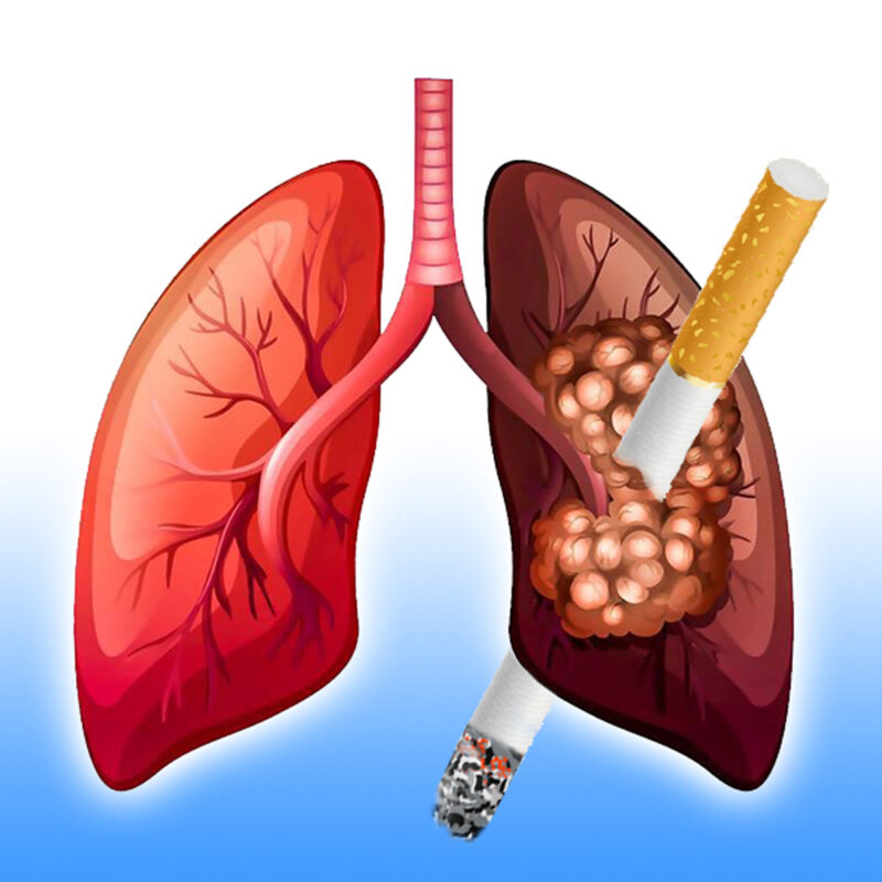 lung cancer and smoking cigarette tobacco carcinogen risk
