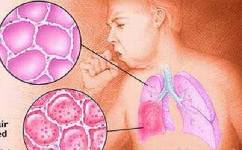 lung cancer cough mechanism bronchial tumor airway