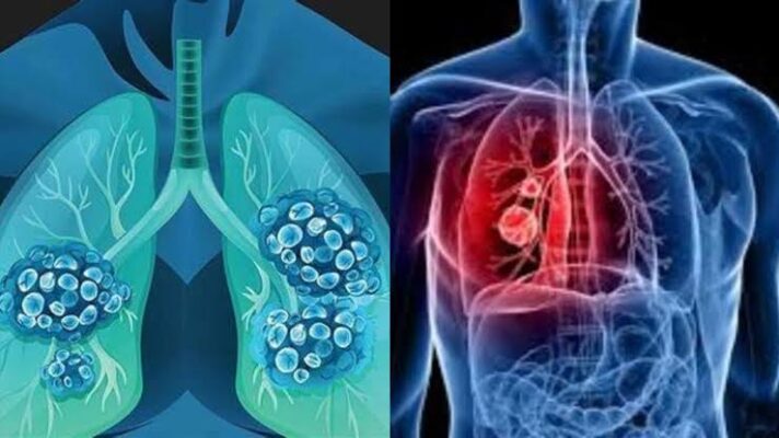 lung cancer early detection LDCT screening scan