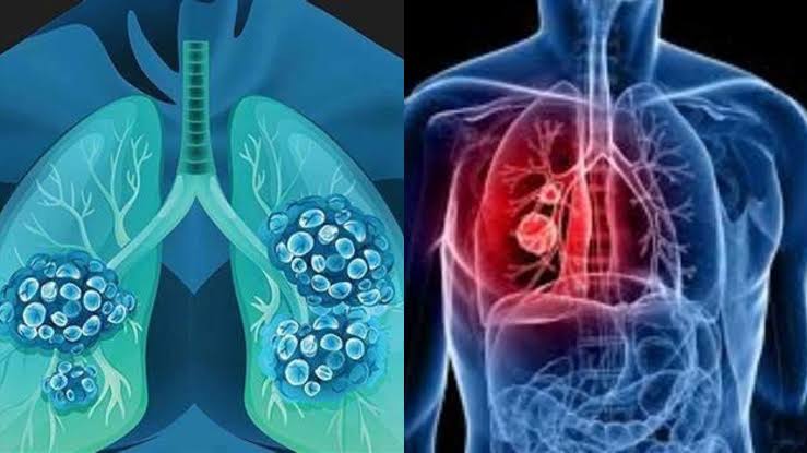 lung cancer early detection LDCT screening scan
