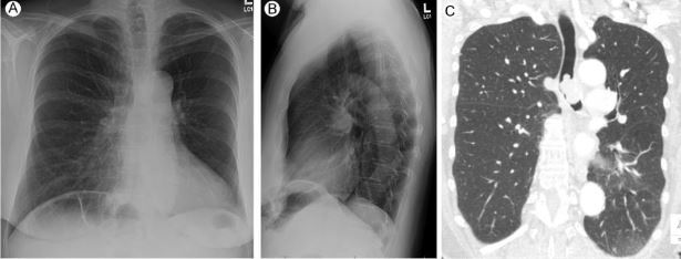 lung cancer screening low dose CT scan LDCT