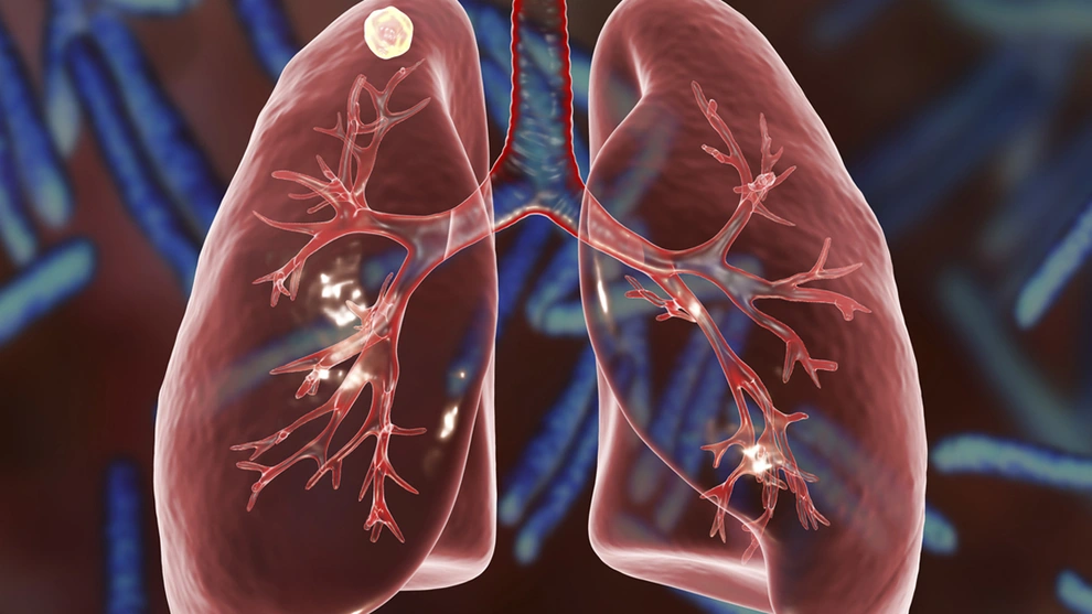lung nodule CT scan pulmonary nodule