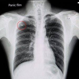 lung nodule CT scan size measurement