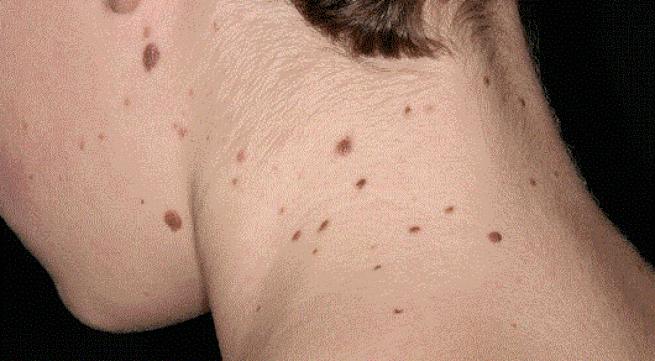 Melanoma skin lesion showing characteristic ABCDE warning signs