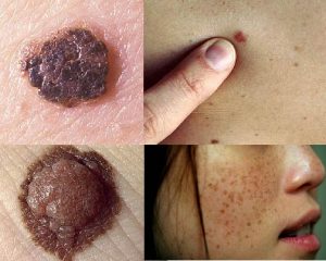Melanoma symptom comparison showing benign mole versus melanoma lesion