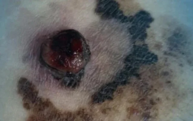 Melanoma symptoms showing ABCDE warning signs on skin lesion