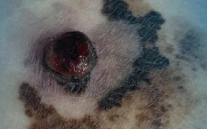 Melanoma symptoms showing ABCDE warning signs on skin lesion