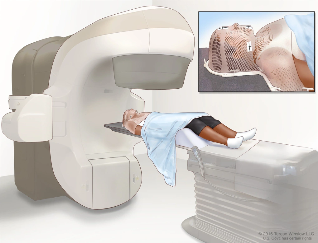 Minimally invasive cancer treatment with stereotactic body radiation therapy SBRT targeting tumor with precision beams