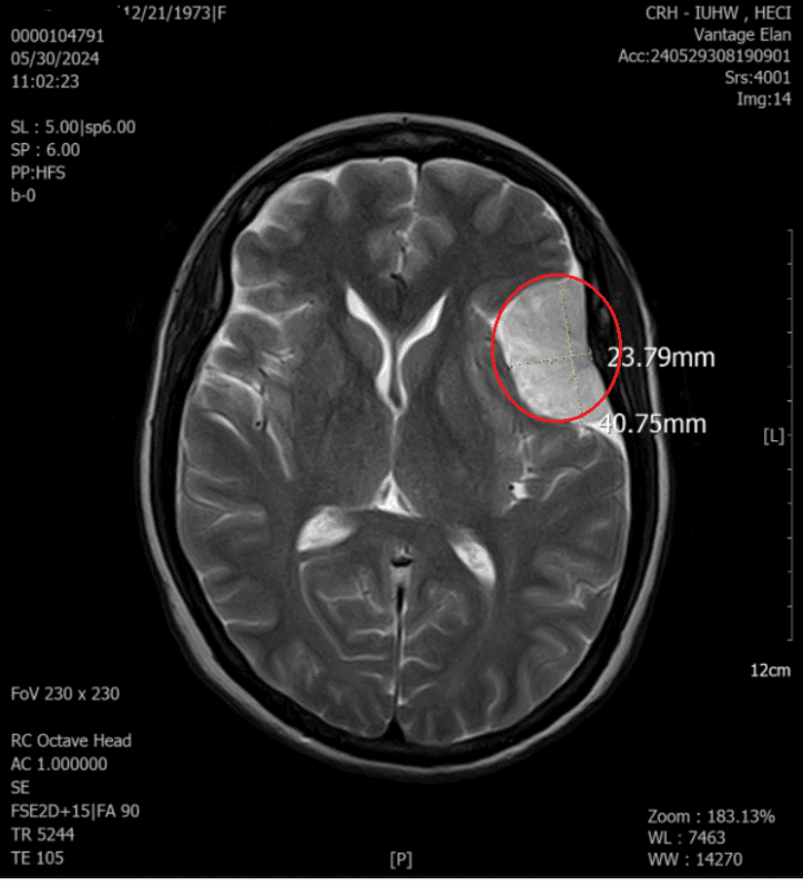 MRI for cancer whole-body scan showing tumor detection with no radiation
