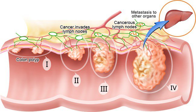 MRI for cancer prostate staging showing PI-RADS assessment with multiparametric sequences