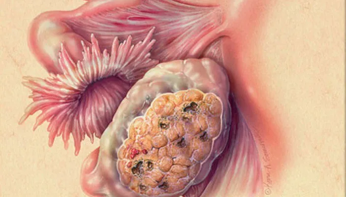 ascites in ovarian cancer — fluid accumulation causing severe abdominal distension