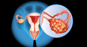 Ovarian cancer BRCA1 and BRCA2 mutation risk factors and hereditary ovarian cancer