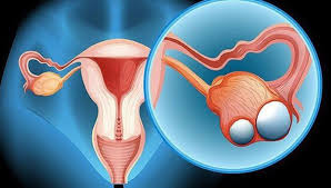 Ovarian cancer — symptoms, risk factors, and treatment overview
