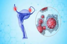 ovarian cancer risk factors — genetic mutations, reproductive history, and hormonal factors that increase or decrease ovarian cancer risk