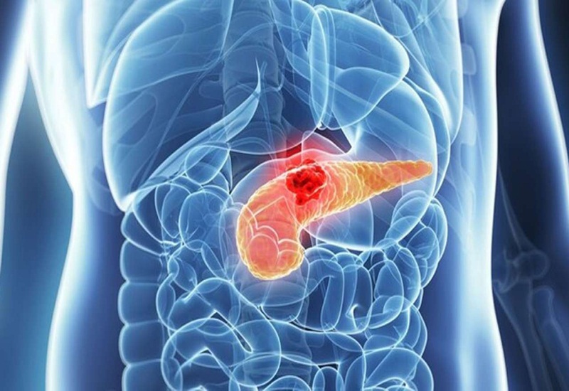celiac plexus neurolysis for pancreatic cancer pain — EUS-guided injection procedure for pain relief