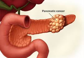 pancreatic cancer back pain — location of celiac plexus pain in upper lumbar and mid-back region