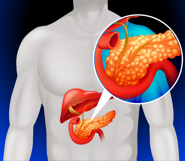 pancreatic cancer symptoms and diagnosis — CT scan showing pancreatic tumor with biliary obstruction and dilated bile ducts