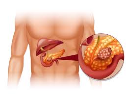 pancreatic cancer anatomy — tumor location in the head, body, and tail of the pancreas showing relation to bile duct and surrounding organs