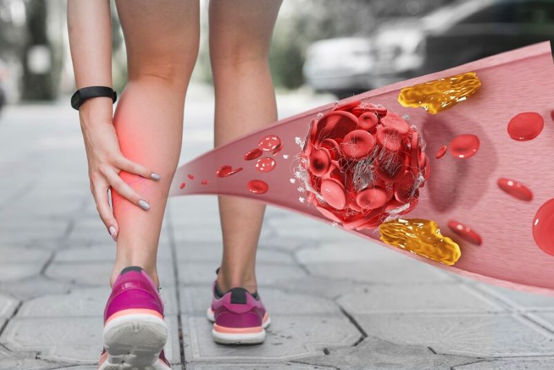 Diagram illustrating how peripheral artery disease narrows leg arteries and reduces blood flow, causing claudication and limb ischemia