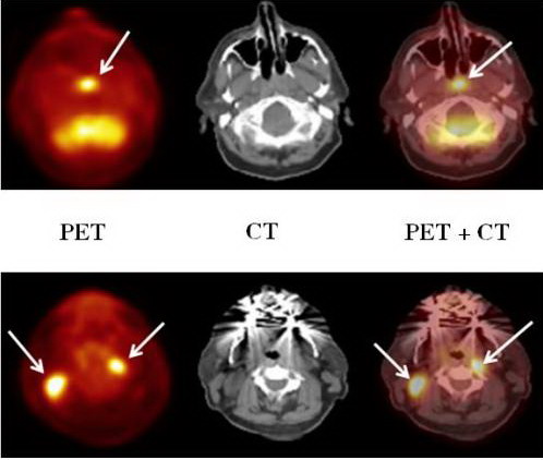 PET scan for cancer showing FDG uptake hot spots indicating tumor metabolic activity