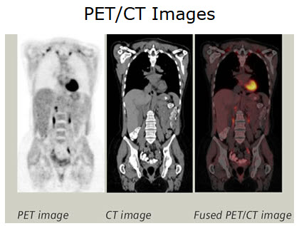 PET-CT scan for cancer showing fused metabolic and anatomic imaging for tumor localization