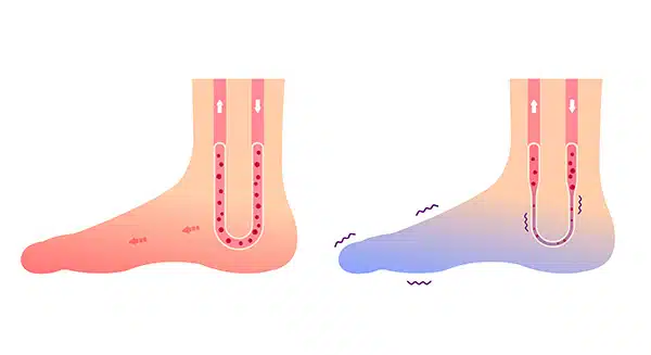 Diagram comparing healthy blood circulation with poor circulation showing narrowed vessels and restricted flow