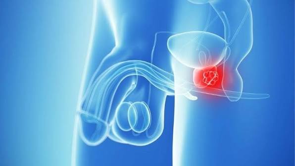 prostate cancer risk hereditary genetics BRCA2 family history