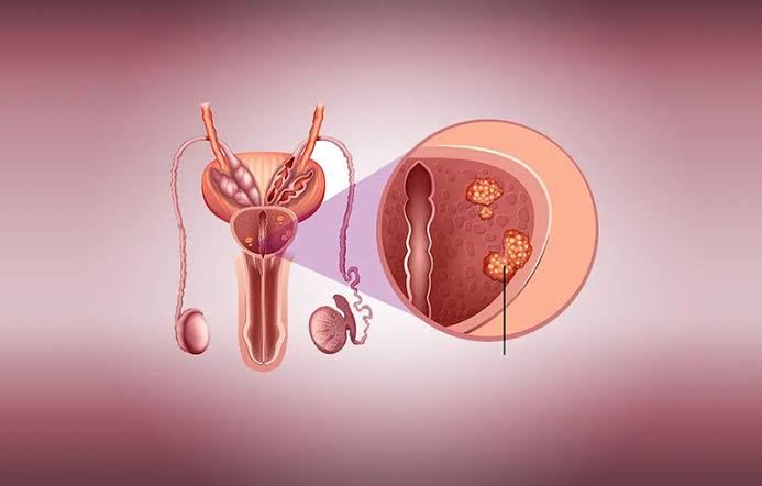 prostate cancer risk factors age race genetics lifestyle