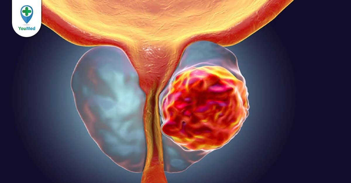 prostate cancer symptoms urinary pain bone