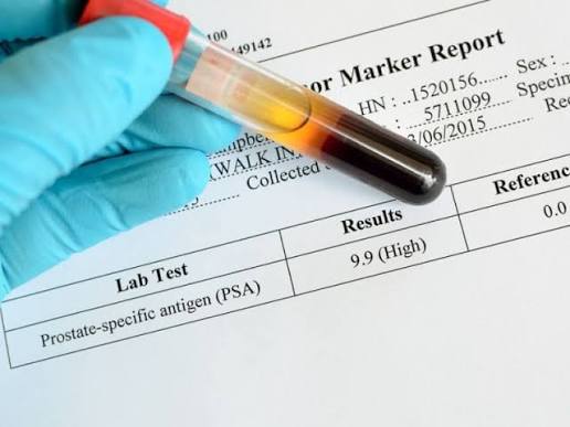 PSA test free total PSA interpretation