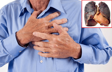 shortness of breath lung cancer dyspnea patient