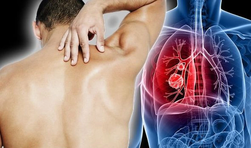 shortness of breath lung cancer pleural effusion mechanism