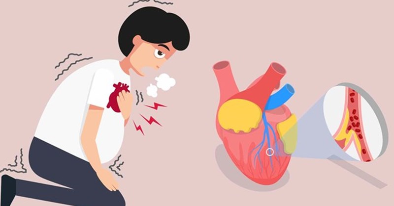 silent heart attack symptoms myocardial infarction without recognized symptoms risk diabetes