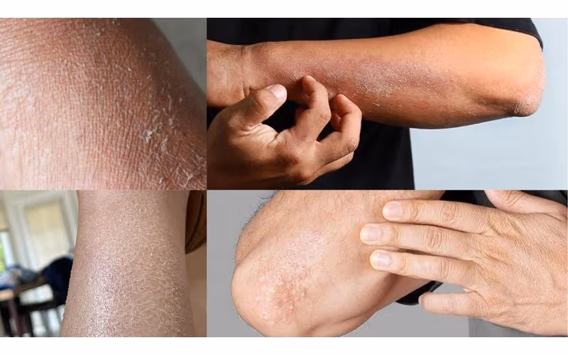 ABCDE rule for melanoma detection — asymmetry border color diameter evolution