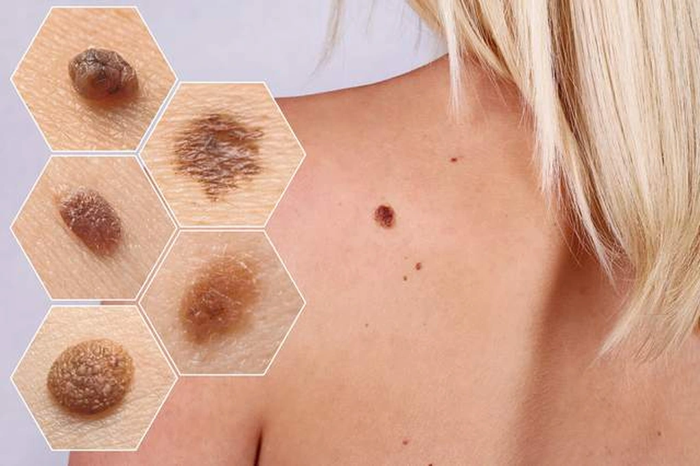 Skin cancer screening self-examination guide showing areas to check