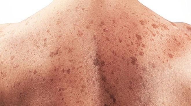skin cancer symptoms — suspicious mole showing ABCDE warning signs for melanoma