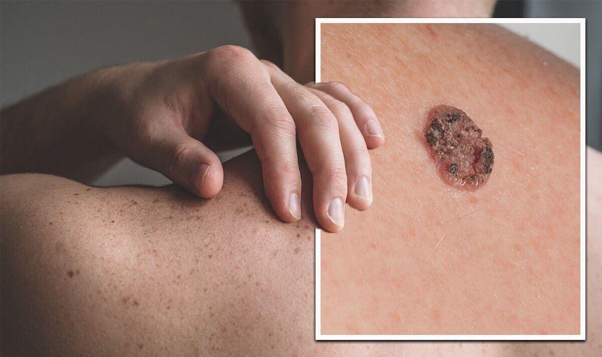 Skin Changes and Cancer: When What You See on the Surface Reflects What's Inside