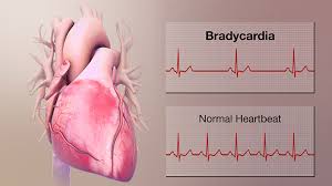 Slow heart rate bradycardia causes and when to seek care